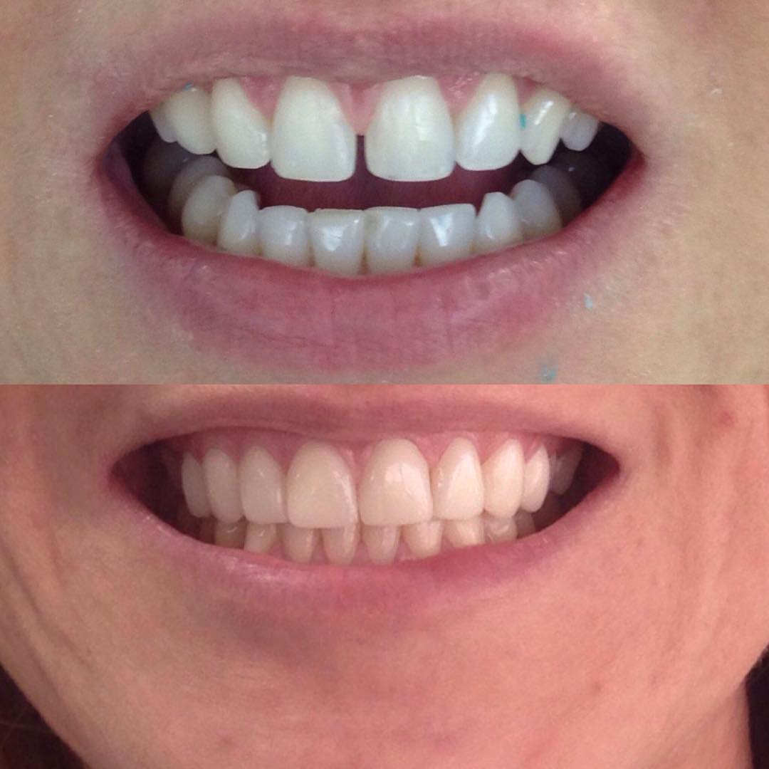 Alinhamento e Estética — antes e depois